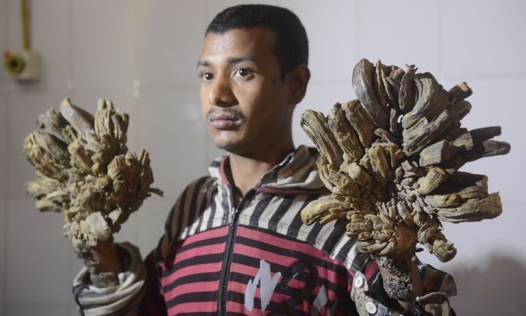 ‘Tree Man’ Set For Life-Changing Surgery In Bangladesh