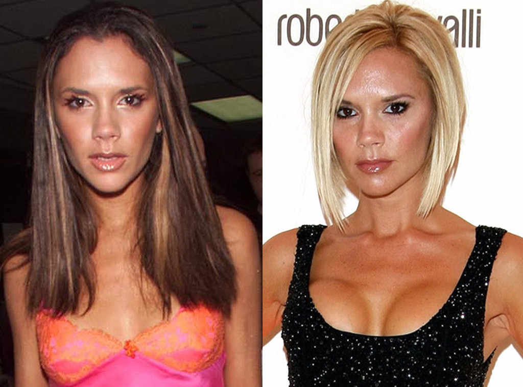 8 Celebrities Who Have Openly Admitted To Having Plastic Surgery 2