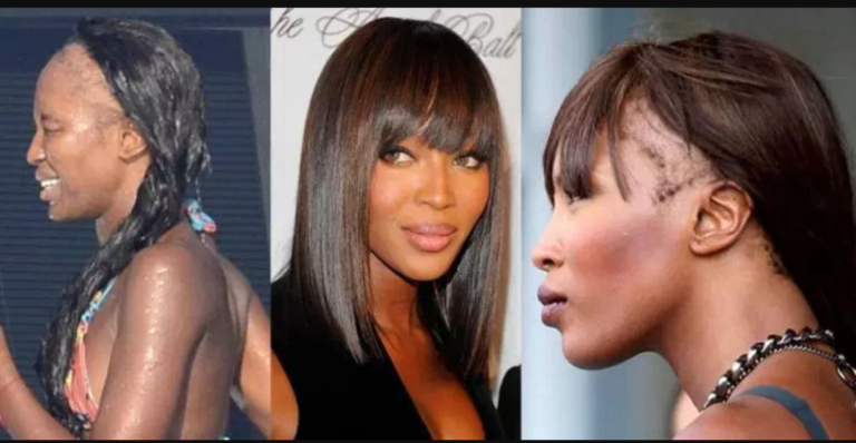 Celebrities With Hair Transplants